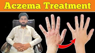 aczema Treatment | ایکزیما کا علاج | aczema ka ilaj | dermovate nn ointment | tablet Zyrtec uses