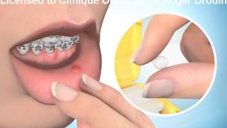 Cire en orthodontie