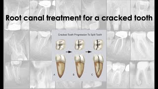 Root canal treatment for a Cracked tooth