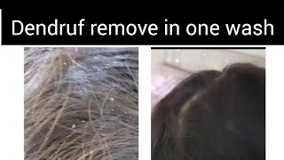 How to remove Dandruff in one wash. (home remedies)