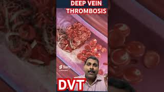 DEEP VAIN THROMBOSIS