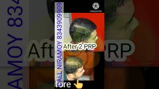 PRP TREATMENT Before and After | PRP Cost | PRP Hair TREATMENT #shorts