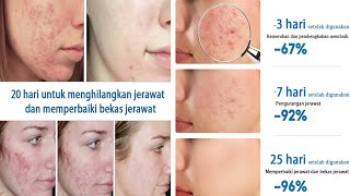 Cream penghilang jerawat dan bekas jerawat cepat dalam 7 sampai 20 hari