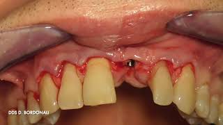 Implant on Central incisor with ctg And immediate loading