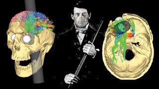 Phineas Gage Vakası | Ölüme Meydan Okuyan Adam | Frontal Korteks Hasarı