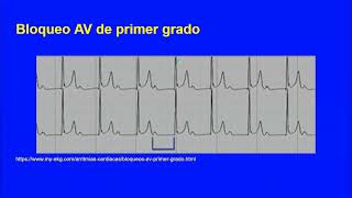 Bradiarritmias  Dr  Fata