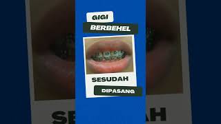 Gigi Jarang Pasang Behel