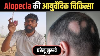 Alopecia की आयुर्वेदिक चिकित्सा :  @HelloUpchar