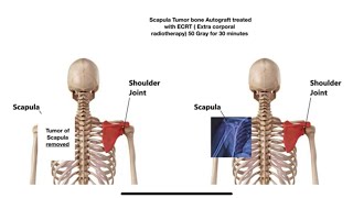 Ewings Sarcoma Scapula or Shoulder blade bone tumor surgery