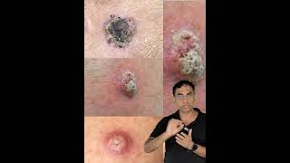 WARTS  എന്താണ്?എങ്ങനെയാണ് ചികിത്സിക്കുന്നത്?DR KHALEEL VLOG