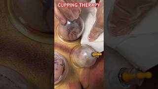 CUPPING THERAPY 🔥||#health #cuppingtherapy #viral #alternativemedicine