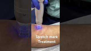 Stretch mark treatment at Dermosphere Clinic with SCARLET #stretchmarkremoval