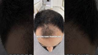 HAIR TRANSPLANT AFTER 6 MONTHS | HAIR TRANSPLANT RESULT