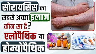 Psoriasis best treatment: homeopathy, allopathy, ayurvedic | Homeopathic VS Allopathic In Hindi