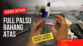 Cara Membuat Gigi Palsu Full Atas Secara instan