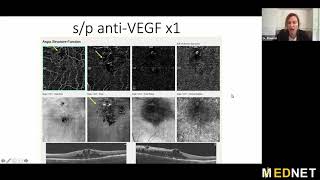 New Paradigms for Treatment and Management of Retinal Vein Occlusion (RVO)