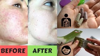 HOW I CLEARED MY SKIN IN 1 WEEK NATURALLY!