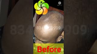 PRP Hair Loss Treatment Before and After | PRP Results | Platelet Rich Plasma