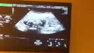 23 week ultrasound