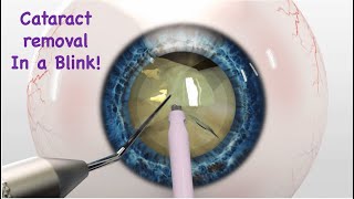 Cataract Removal Surgery/ Eye surgery