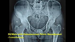 Hemipelvectomy Surgery for Pelvic Bone tumors : Walking video after surgery