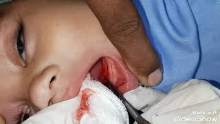 Lingual Frenectomy