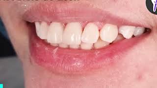 দাঁতের ফিলিংDirect Veneers Composite #Preparation #Tips #Tricks #daily #teeth #ফাঁকা #enamel