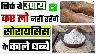 Psoriasis treatment without medicine | सोरायसिस (छाल रोग) के काले धब्बे को करें घर बैठे ठीक