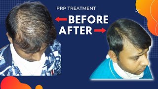 PRP Treatment Full Process  | You should watch |