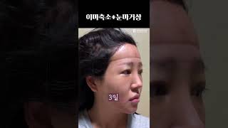 내가 왜 이뻐졌게? #plasticsurgeryinkorea