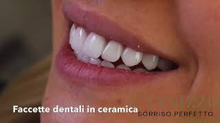 Faccette dentali del Dr Cannizzo