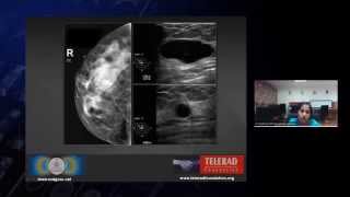 Radiology Teaching on Benign Breast Diseases by Dr Chethana SM