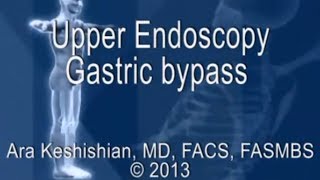 Upper Endoscopy Gastric Bypass