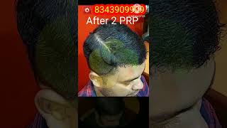 prp hair loss treatment before and after | prp hair treatment