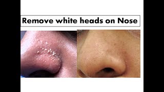 Turmeric to  remove White heads on Nose| Starnaturalbeauties