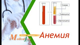 Анемия (низкий гемоглобин): симптомы, диагностика, лечение, профилактика