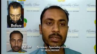 Hair Transplant in Kolkata-Asansol-Bhubaneswar | FUE Hair Transplant | Niramoy Speciality Clinic