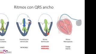 15 - Taquicardia ventricular (TV)