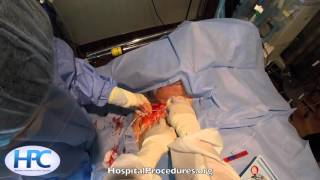 Subclavian Vein Central Venous Catheter Insertion