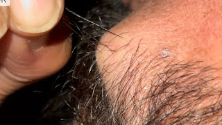 ASMR Beard Satisfying Oddly | Ingrown 10 ingrown