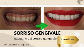 Sorriso Gengivale