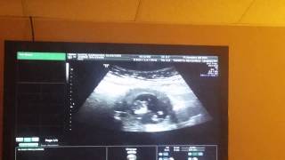 Ultrasound at 10 weeks