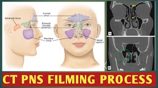 NCCT PNS FILMING PROCESS #CT PARANASAL SINUSES #CT PNS FILMING