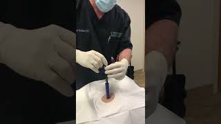 Bone Marrow Aspiration Technique with Marrow Cellution