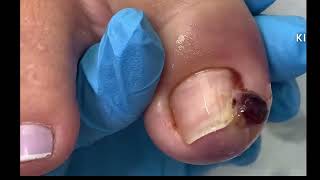 Unha encravada, granuloma gigante | Ingrown toenail, giant granuloma! #nails #podologia #dor