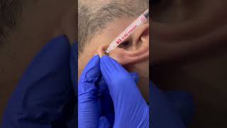 Keloid injection #keloidtreatment #keloidremoval