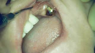 Infiltration anesthesia technique for implantation missing 2.4 teeth.