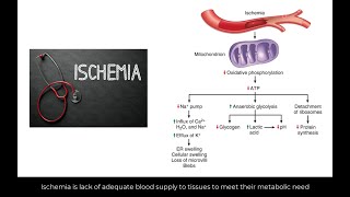 Consequence of ischemia