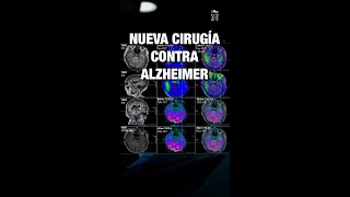 China tiene nueva cirugía experimental contra el Alzheimer