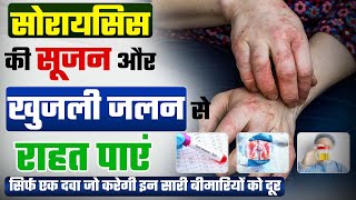 Psoriasis itching  relief | सोरायसिस की सूजन और खुजली जलन से राहत पाएं